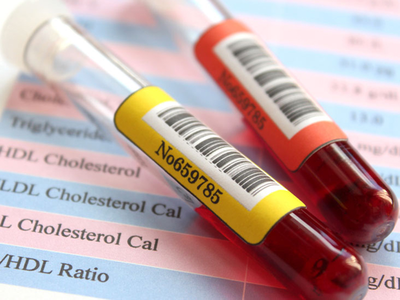 Từ 20 tuổi trở lên là độ tuổi có thể bắt đầu xét nghiệm mức cholesterol cũng như HDL trong máu